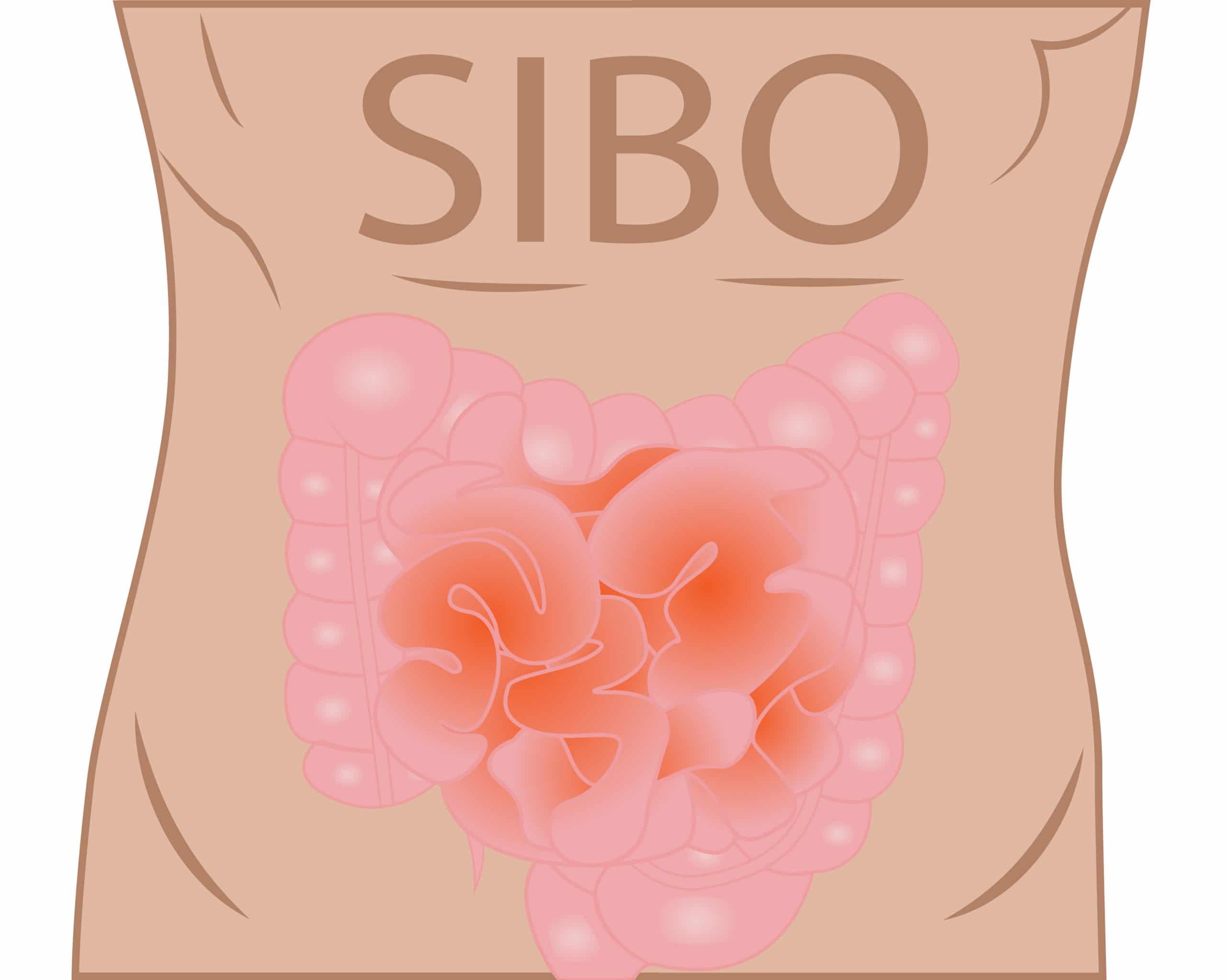 Small Intestinal Bacterial Overgrowth SIBO