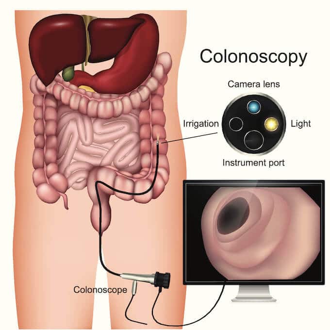 Colonoscopy